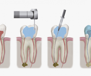 ¿Qué es una endodoncia y en qué ocasiones hay que hacerla?